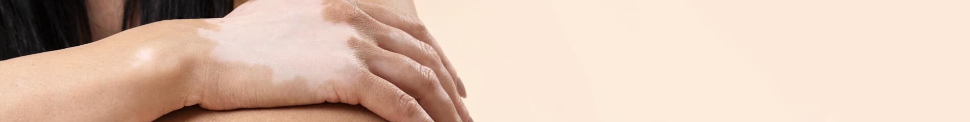 National Eczema Society
